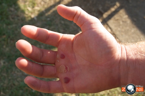 What 120mph Can Do To your Hand Just Ask Weaves What 120mph Can Do To your Hand Just Ask Weaves